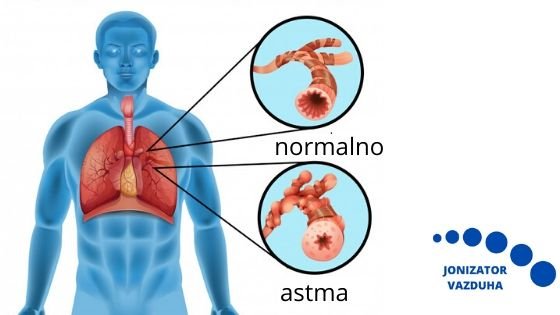 astma jonizator vazduha
